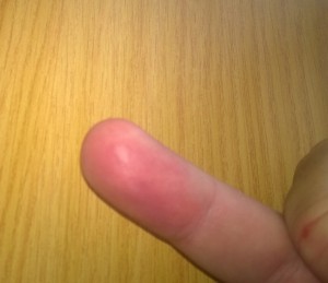 My Nokia Lumia het 'n blaas op my vinger gebrand.